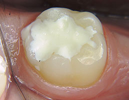 Цемент для детских зубов